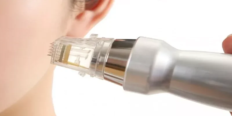 Altın İğne (Fraksiyonel Radyofrekans)